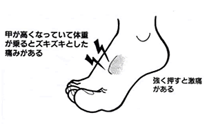 足の甲の痛み リスフラン関節症 公式 浮き指研究の第一人者 笠原巖の浮き指専門サイト