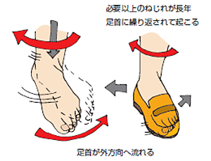 足首の慢性痛 公式 浮き指研究の第一人者 笠原巖の浮き指専門サイト