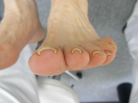 巻き爪の足